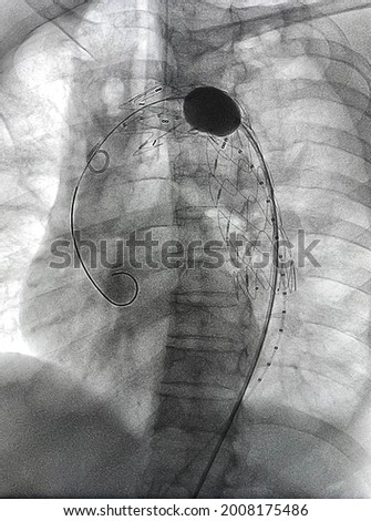 Stent graft balloon catheter was inflated after stent  graft deployed at descending aorta during Thoracic endovascular aortic repair (TEVAR). Royalty-Free Stock Photo #2008175486