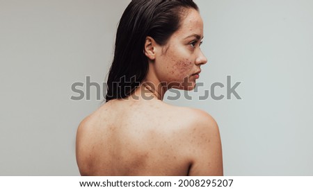 Portrait of woman having acne inflammation on face and body. Rear view close up of woman with pimples on face. Royalty-Free Stock Photo #2008295207
