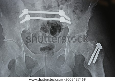 Plain x ray with a fracture pelvis that is fixed with 4 screws and 2 rods and fracture of greater trochanter of femur fixed with 2 screws and fracture of symphysis pubis, ileo-iliac pelvic fixation Royalty-Free Stock Photo #2008487459
