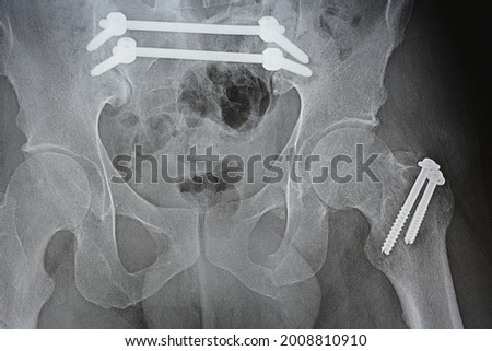 Plain x ray with a fracture pelvis that is fixed with 4 screws and 2 rods and fracture of the left greater trochanter of femur fixed with 2 screws and fracture of the left part of the symphysis pubis Royalty-Free Stock Photo #2008810910