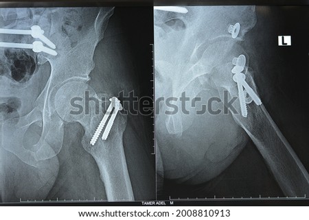 Selective focus of a plain x ray on left hip joined with a fracture of the greater trochanter of femur fixed with 2 screws in an open reduction surgery and a fracture of symphysis pubis after accident Royalty-Free Stock Photo #2008810913