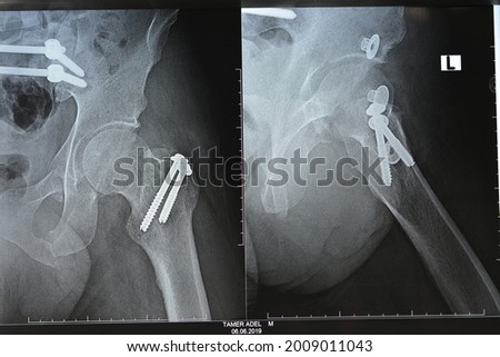 Selective focus of a plain x ray on left hip joined with a fracture of the greater trochanter of femur fixed with 2 screws in an open reduction surgery and a fracture of symphysis pubis after accident Royalty-Free Stock Photo #2009011043