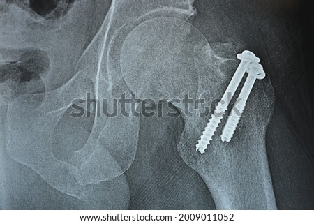 Selective focus of a plain x ray on left hip joined with a fracture of the greater trochanter of femur fixed with 2 screws in an open reduction surgery and a fracture of symphysis pubis after accident Royalty-Free Stock Photo #2009011052