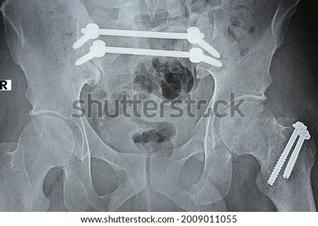 Plain x ray with a fracture pelvis that is fixed with 4 screws and 2 rods and fracture of the left greater trochanter of femur fixed with 2 screws and fracture of the left part of the symphysis pubis Royalty-Free Stock Photo #2009011055