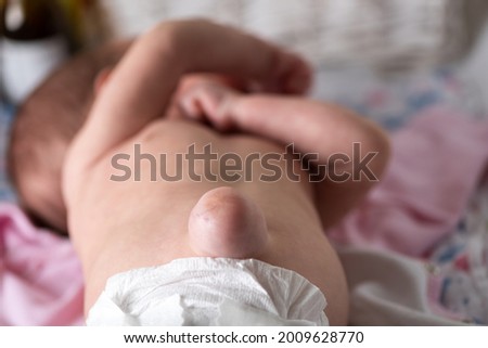 Large umbilical hernia in premature newborn baby Royalty-Free Stock Photo #2009628770