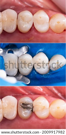 mercury filling replacment with light cure white esthetic composite filling Royalty-Free Stock Photo #2009917982