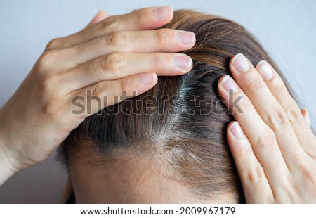 Cropped view of Asian woman forehead with part of her thin hair, she had hair loss problem. Female pattern hair loss can progress from a widening part to overall thinning. Royalty-Free Stock Photo #2009967179