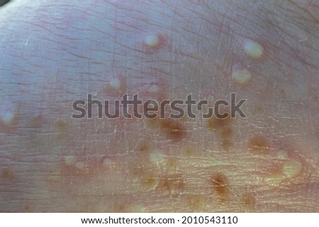 Macro photo of pustules on the hand palm, pustular psoriasis lesions, Palmoplantar psoriasis Royalty-Free Stock Photo #2010543110