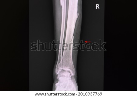 X-ray film of a patient with closed non displaced spiral fracture of right tibia (lower leg bone). Royalty-Free Stock Photo #2010937769
