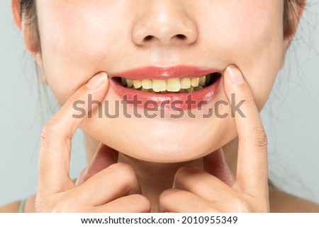 The teeth of the women are yellowed. Royalty-Free Stock Photo #2010955349