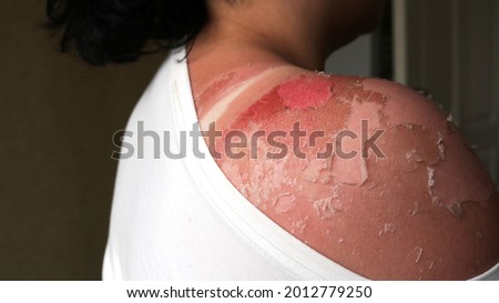woman with burnt back and shoulders, lowered white T-shirt, showing high degree sunburn and wounds and scars on damaged skin, severe skin damage after exposure to the sun Royalty-Free Stock Photo #2012779250