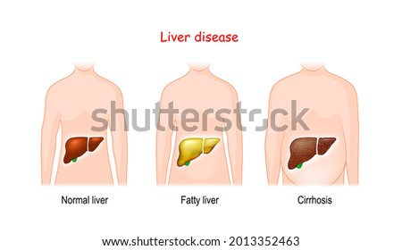 Liver diseases. Stages of liver damage. Healthy, fatty,  and cirrhosis. human body with illuminated healthy and diseased internal organs. Vector illustration