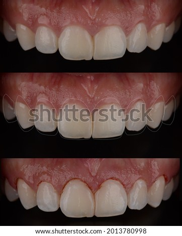 Gum surgery procedure from clinical steps to planning and gum lifting.