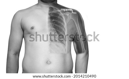 Closeup Body human x-ray of shoulder showing fracture of distal clavicle or collarbone. need surgery in operating room Fracture of the distal clavicle which was treated using hook plate fixation. Royalty-Free Stock Photo #2014210490