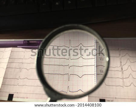ECG of a healthy person. Magnifier magnifies one PQRST complex. In a background a purple pen.