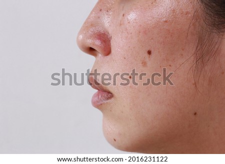 Facial skin problems for women and health problems Dark spots with freckles and blemishes with copy space Royalty-Free Stock Photo #2016231122