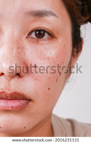 Close-up of women's skin health problems with black spots and rashes on the half of the face and copy space Royalty-Free Stock Photo #2016231131