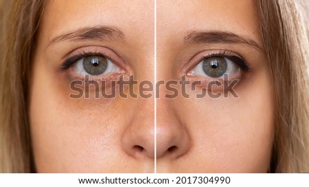 Cropped shot of a young female face. Female green eyes with bruise under eye before and after cosmetic treatment. Dark circles under the eyes