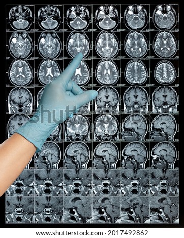  MRI brain scan or magnetic resonance image results, neurology point a finger