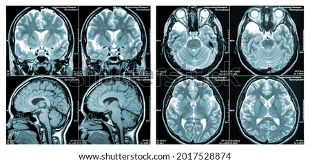 MRI Scan image of a human brain showing all main multiple sclerosis Royalty-Free Stock Photo #2017528874
