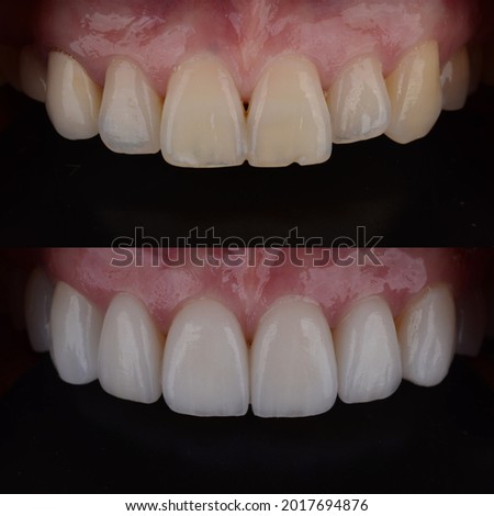 Teeth makeover into white and beautiful final result. Cosmetic smile makeover with ceramic veneers.