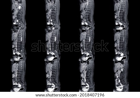 MRI spine showing mass at distal cord and conus medullaris, with tumor seedings at lower spinal canal. The mass appear hypersignal T2 and strong enhancement. DDx. Myxopapillary ependymoma.