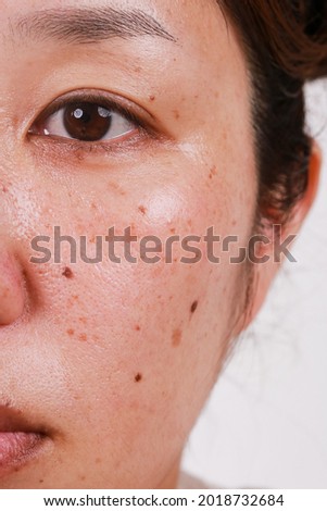 Macro skin, face, woman, portrait with large pores Dark spots care for problem skin with close-up half face. Royalty-Free Stock Photo #2018732684
