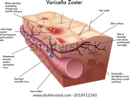 Medical illustration of a section of skin affected by varicella zoster virus, with annotations. Royalty-Free Stock Photo #2018912360