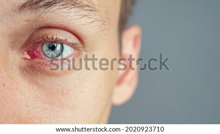 Close up of the red eye of a man affected by an infection, copy space Royalty-Free Stock Photo #2020923710