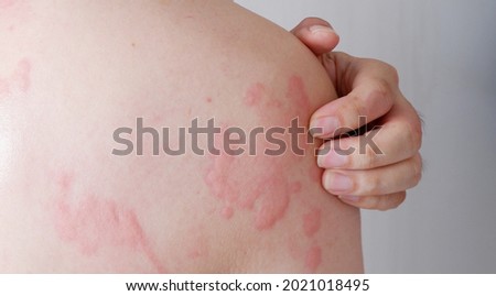 Close up image of skin texture suffering severe urticaria or hives or kaligata. Allergy symptoms. Royalty-Free Stock Photo #2021018495