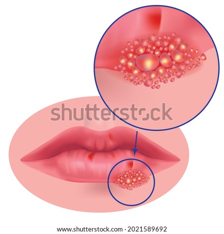 herpes on the lips close up. Vector medical illustration Royalty-Free Stock Photo #2021589692