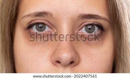 Cropped shot of a young woman's face. Green eyes with dark circles under the eyes and with red capillaries.Bruises under the eyes are caused by fatigue, nervousness, lack of sleep, insomnia and stress