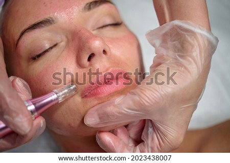 Cosmetician makes microneedling, care to the patient using dermapen Royalty-Free Stock Photo #2023438007
