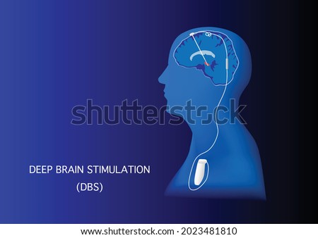 Neuromodulation with deep brain stimulation or DBS for treatment of parkinson disease and various neurological disorders. Royalty-Free Stock Photo #2023481810
