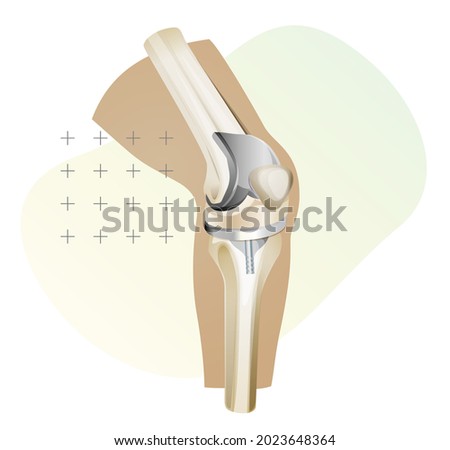 Knee Joint Replacement Surgery - Illustration as EPS 10 File Royalty-Free Stock Photo #2023648364