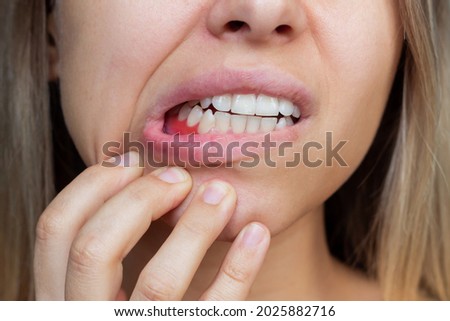 Gum inflammation. Close-up of a young woman showing bleeding gums. Dentistry, dental care Royalty-Free Stock Photo #2025882716