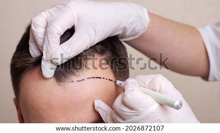 medical professional with gloves draws a dotted line on the head of a balding man. Royalty-Free Stock Photo #2026872107