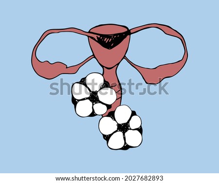 Visualization of the structure of the female reproductive system. Schematic representation of the uterus with cotton