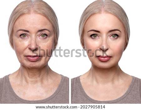 Beautiful woman before and after biorevitalization cosmetic procedures, laser depilation of vellus hair on the face, mesotherapy and smas lifting. Advertising concept for rejuvenation of aging  Royalty-Free Stock Photo #2027905814