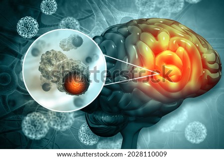 Brain cancer, showing presence of tumor inside brain. 3d illustration