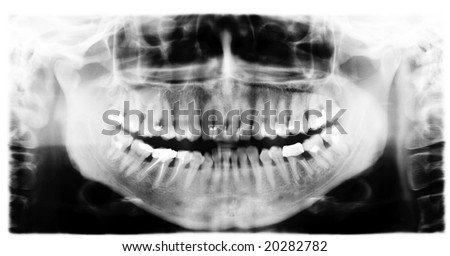 Teeth and jaw  dental  x-ray image