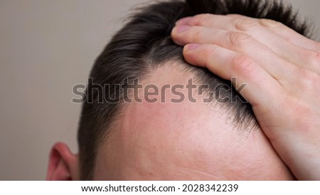 Young man examines his bald spots in the mirror. Royalty-Free Stock Photo #2028342239