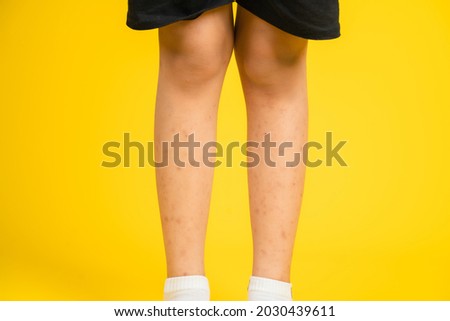 Photo of a little girl's leg with scars on a colored background. Allergy scars.