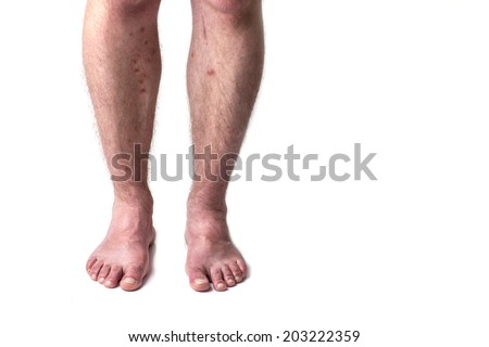 Insect bites on the legs of man