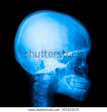 X-ray of head