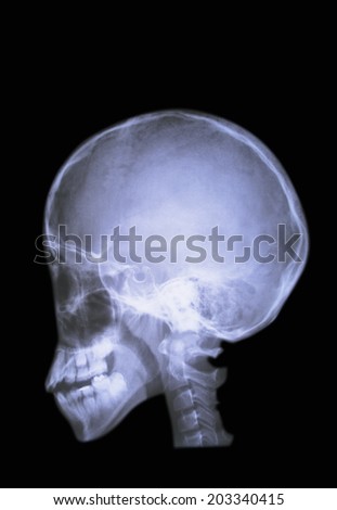 X-Ray Of The Brain