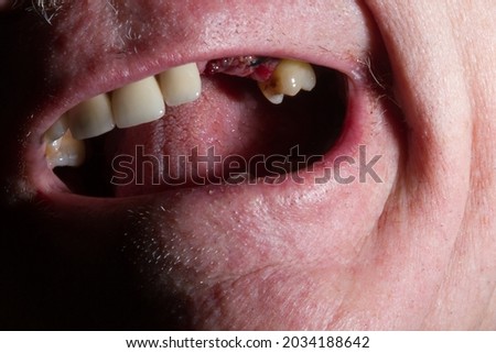 Photo taken one hour after procedure: Endosteal implant in jaw of sixty-five year old male after failure of three crowned teeth.  The two implants will support the bridge of three teeth. Royalty-Free Stock Photo #2034188642