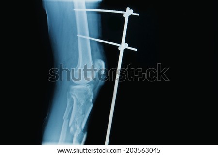 x-ray image of fracture leg ( tibia )with implant external fixation