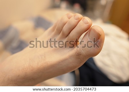 Close-up photo of a male left foot with long toenails and varus big toe. Royalty-Free Stock Photo #2035704473