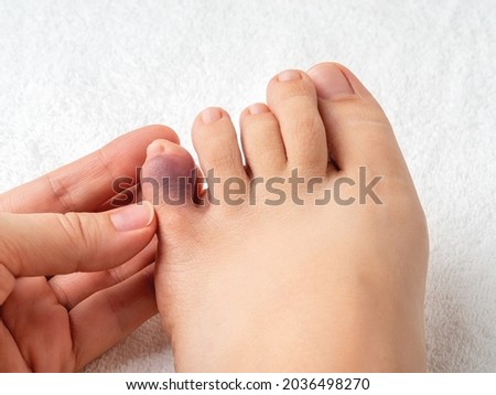 Woman hand touching little toe with purple bruise after home accident. Looking at bruised pinky toe of female person foot. Injury of foot little finger. Broken toe or phalange fracture. Top view. Royalty-Free Stock Photo #2036498270